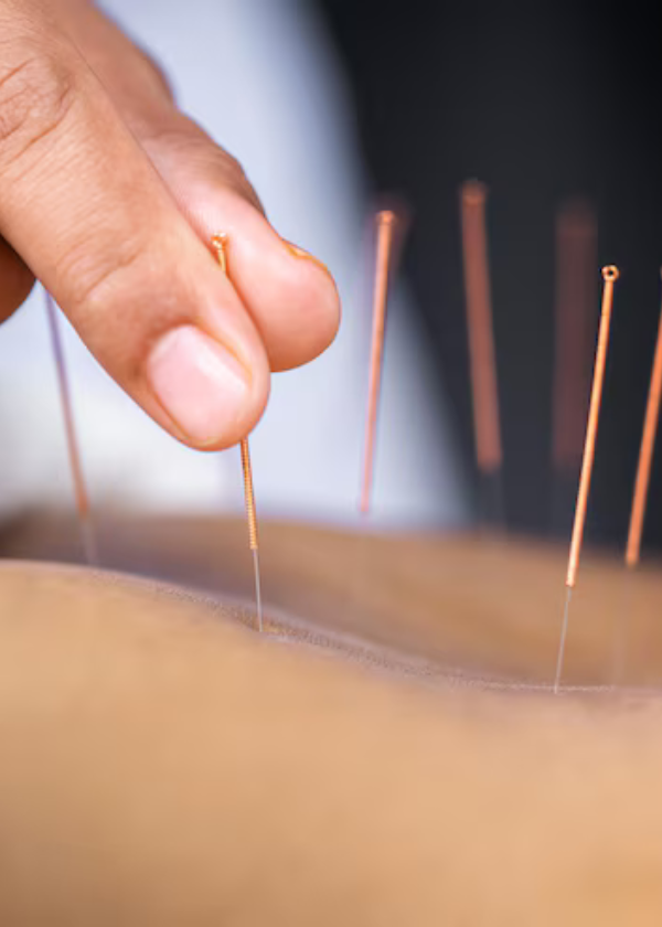 acupuncture
